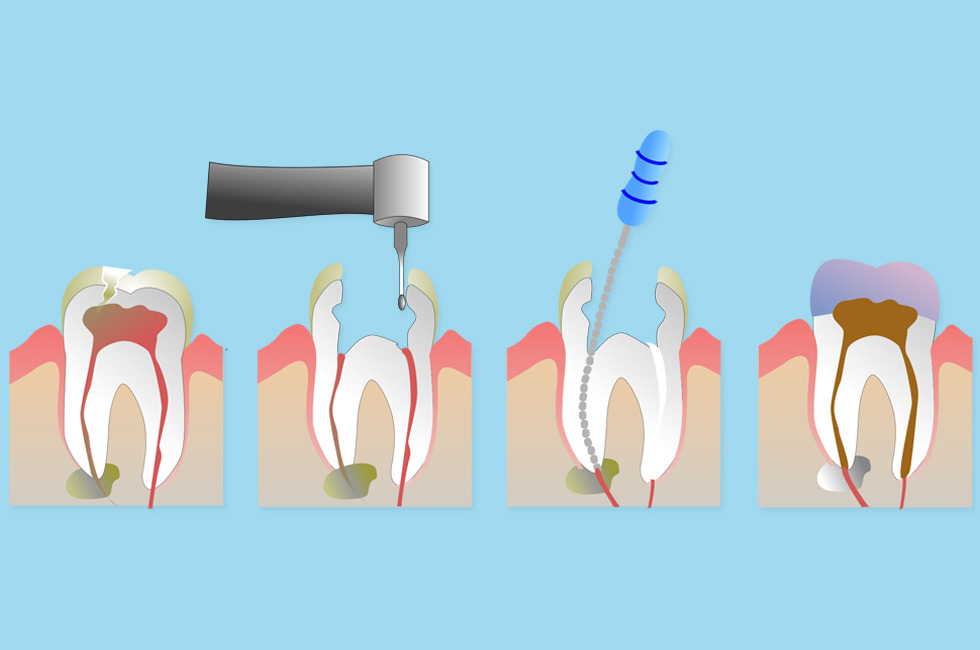 dental Cleaning
