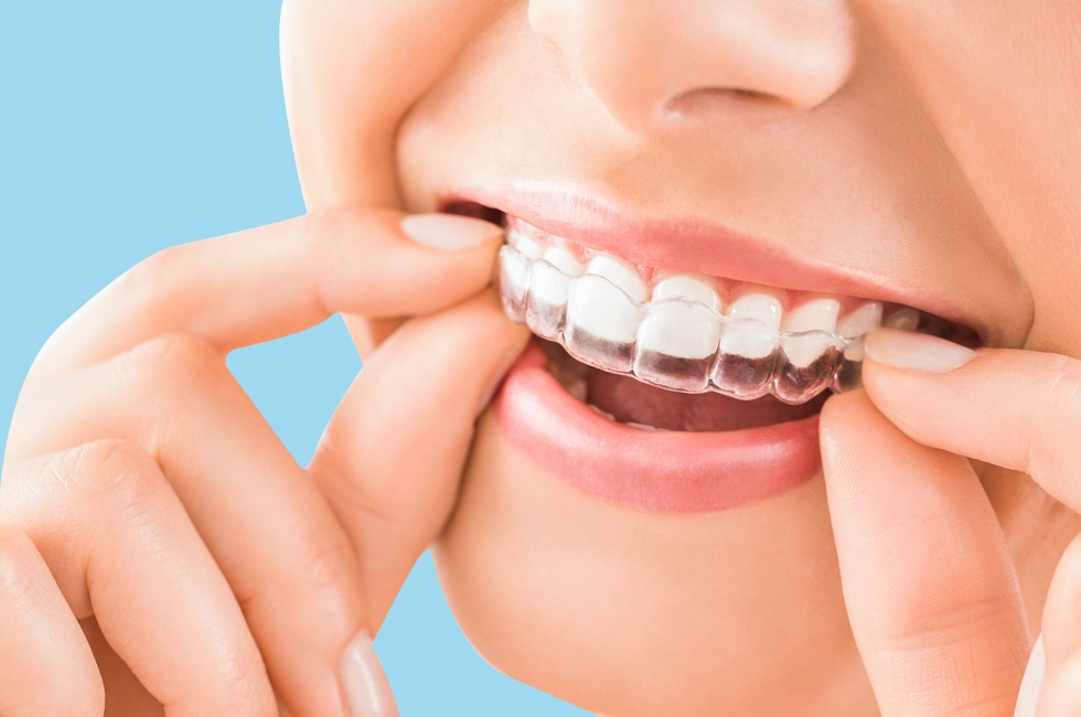Teeth Whitening or Bleaching