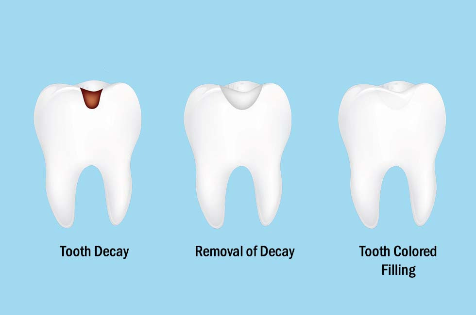 Dental Filling