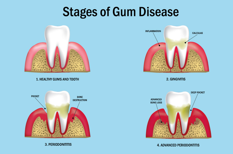 Gum Diseases