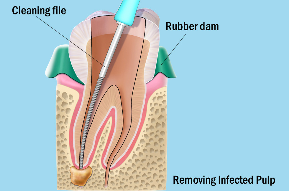 dental Cleaning